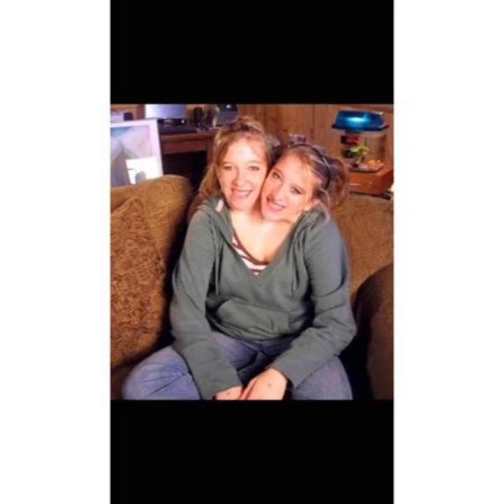 Fascinating Insight: The Age Of Conjoined Twins Abby And Brittany